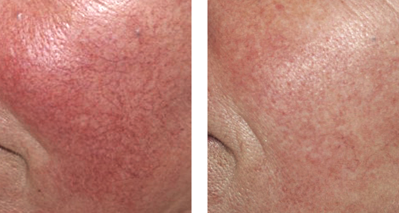 Lasers vasculaires - Laserdermato