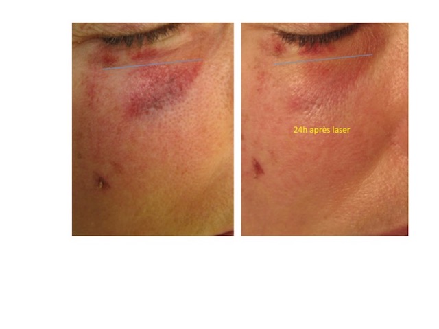 Lasers vasculaires - Laserdermato